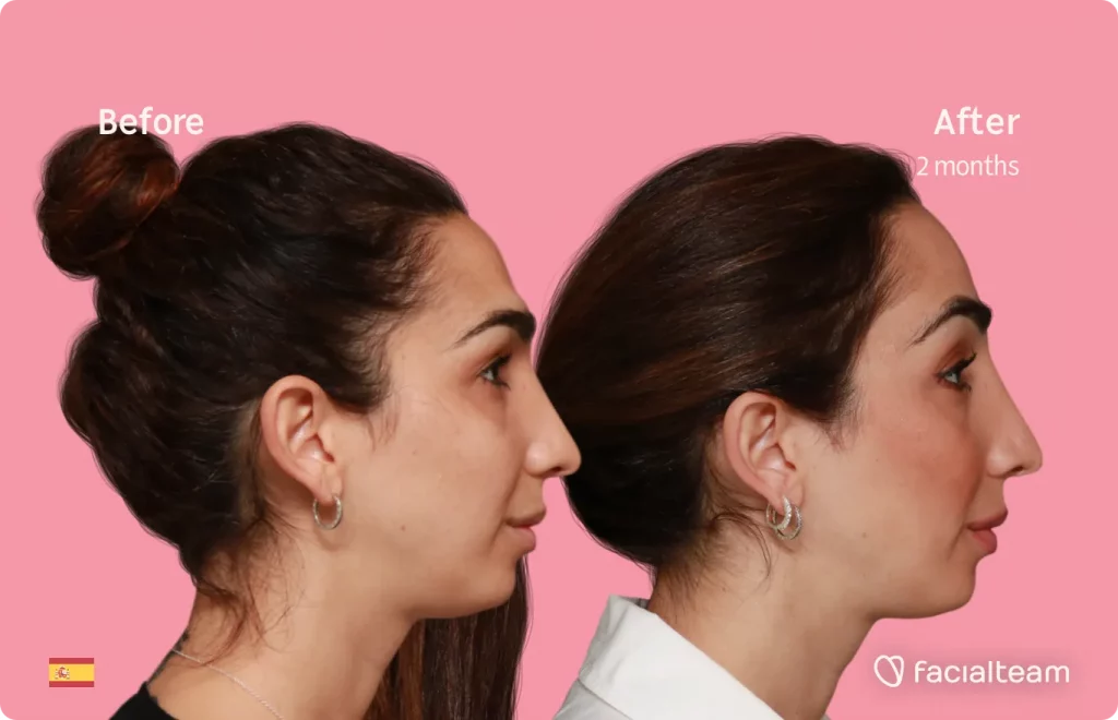 Imagen del lado derecho de la paciente Lola de FFS que muestra los resultados antes y después de la cirugía de feminización facial con Facialteam que consiste en la cirugía de feminización de la frente.