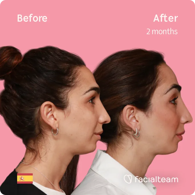 Das rechte quadratische Bild der Patientin Lola zeigt die Ergebnisse vor und nach der Gesichtsfeminisierung mit Facialteam, die eine Feminisierung der Stirn beinhaltet.