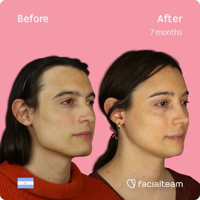 Das 45°-Quadratbild der FFS-Patientin Simone zeigt die Ergebnisse vor und nach der Operation zur Gesichtsfeminisierung, bestehend aus Stirn-, Kiefer- und Kinnfeminisierung und Rhinoplastik.