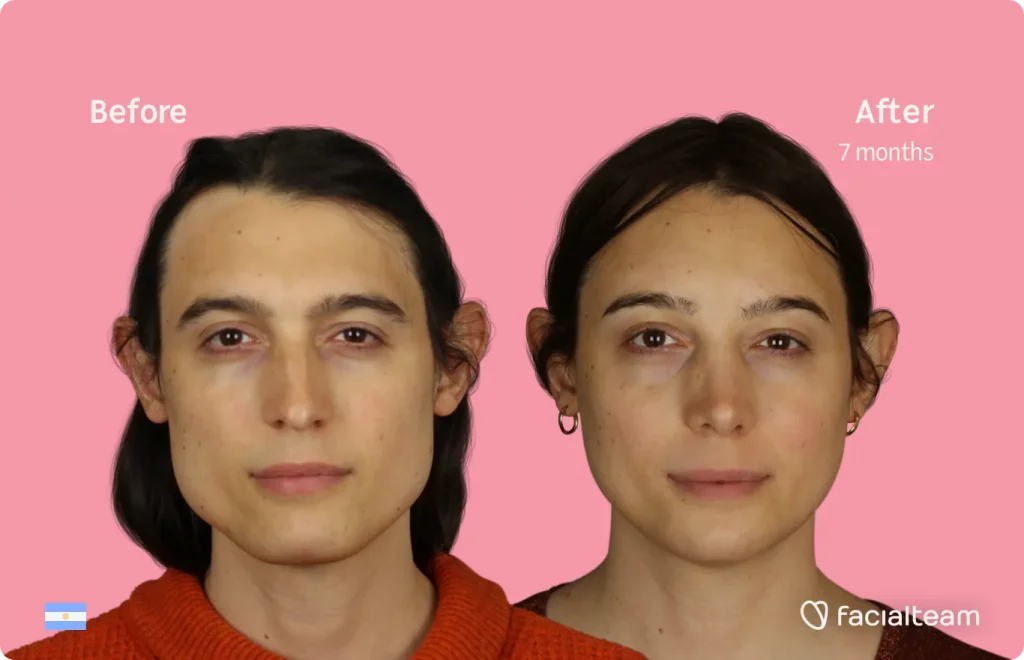 Frontalaufnahme der FFS-Patientin Simone, die die Ergebnisse vor und nach der Feminisierungsoperation mit Facialteam zeigt, die aus einer Feminisierungsoperation der Stirn, des Kiefers und des Kinns sowie einer Nasenkorrektur besteht.