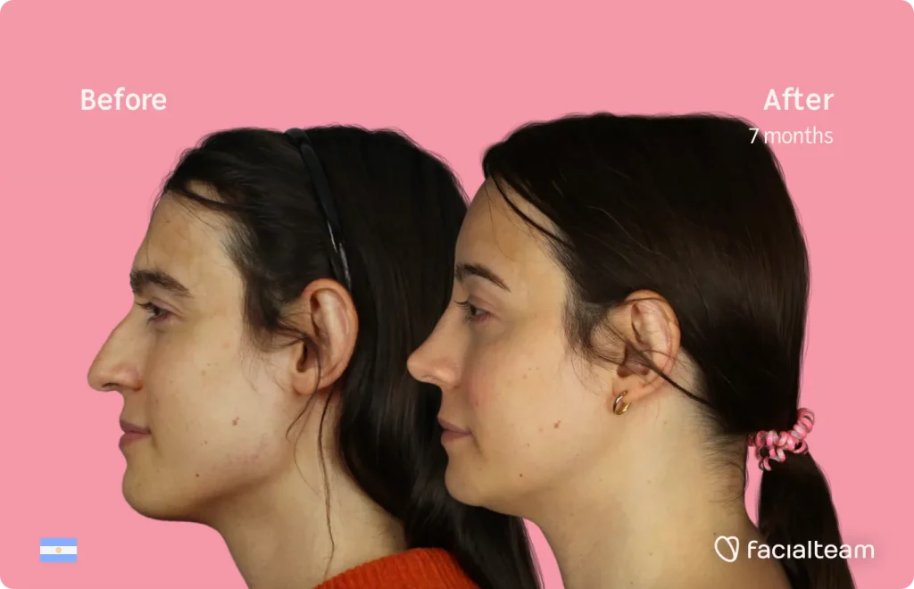 Seitenbild der FFS-Patientin Simone, das die Ergebnisse vor und nach der Gesichtsfeminisierungsoperation mit Facialteam zeigt, die aus einer Feminisierungsoperation der Stirn, des Kiefers und des Kinns sowie einer Nasenkorrektur besteht.