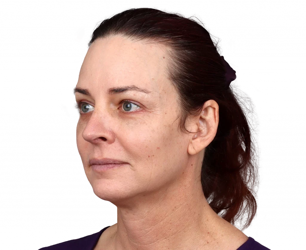 Schräges linkes Profilfoto von Allison nach der Operation.