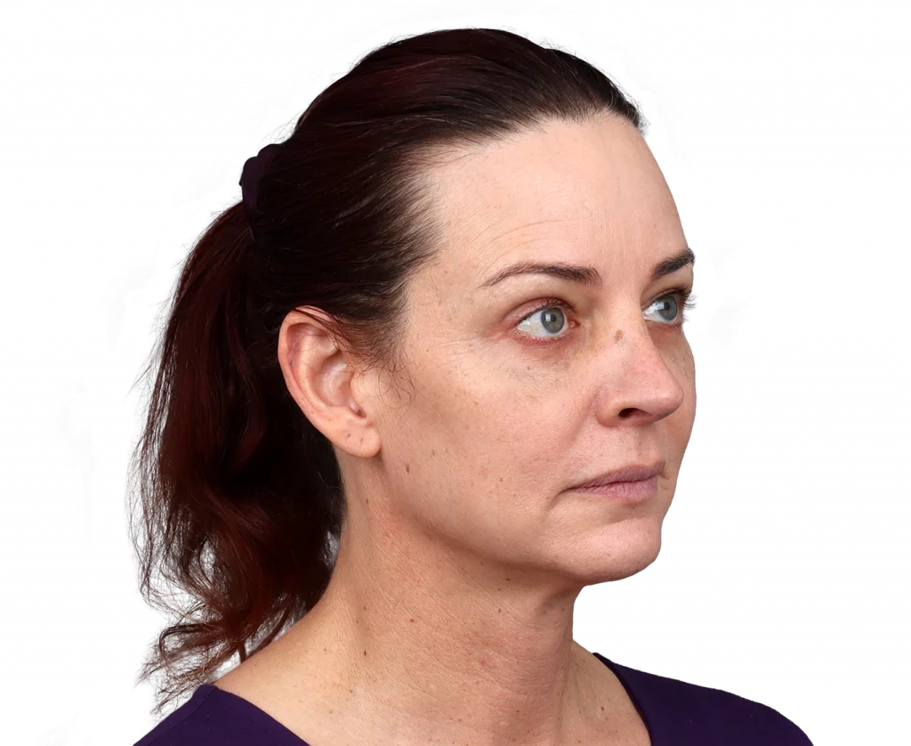 Schräges rechtes Profilfoto von Allison nach der Operation.