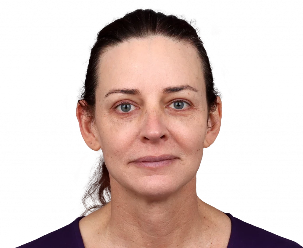 Frontalprofilbild von Allison nach der Operation.