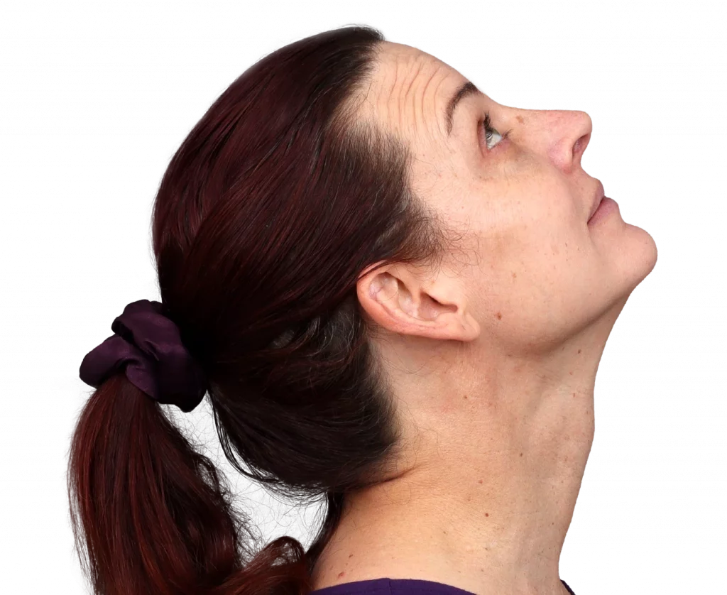 Profilbild von Allison nach der Operation von rechts oben.