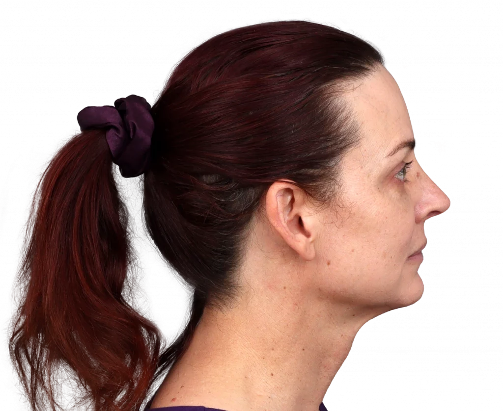 Rechtsseitiges Profilfoto von Allison nach der Operation.