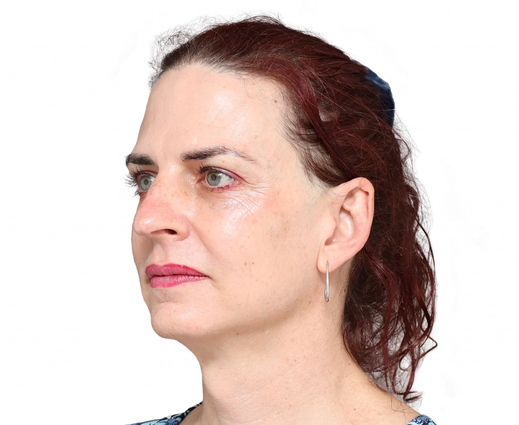 Schräges linkes Profilfoto von Allison vor der Operation.