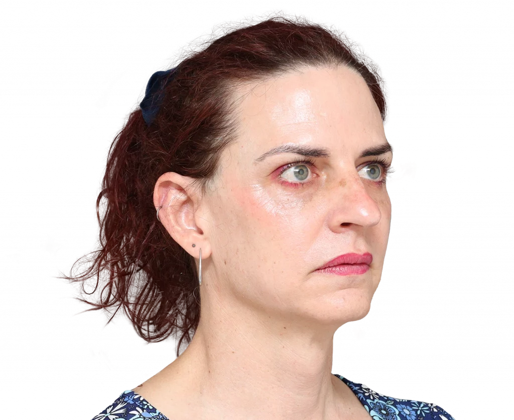 Schräges rechtes Profilfoto von Allison vor der Operation.