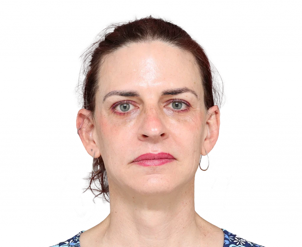 Frontalprofilbild von Allison vor der Operation.
