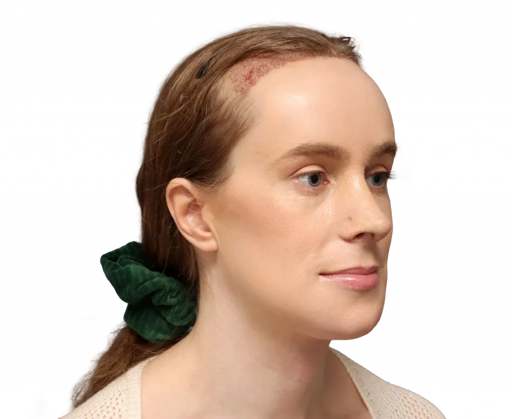 Schräges rechtes Profilfoto von Joanna nach der Operation.