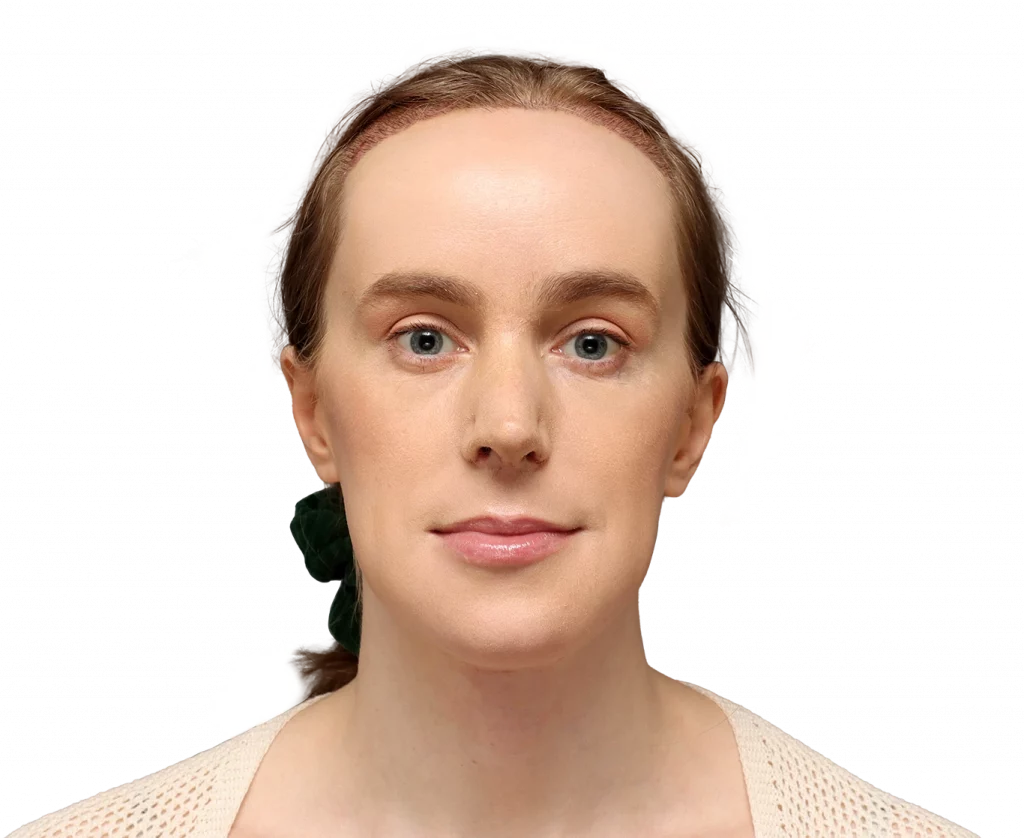 Frontales rechtes Profilfoto von Joanna nach der Operation.