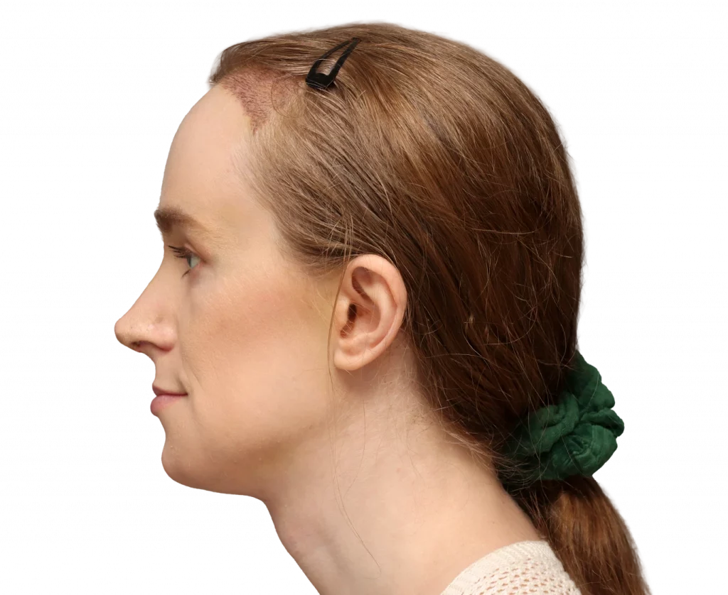 Profilbild links von Joanna nach der Operation.