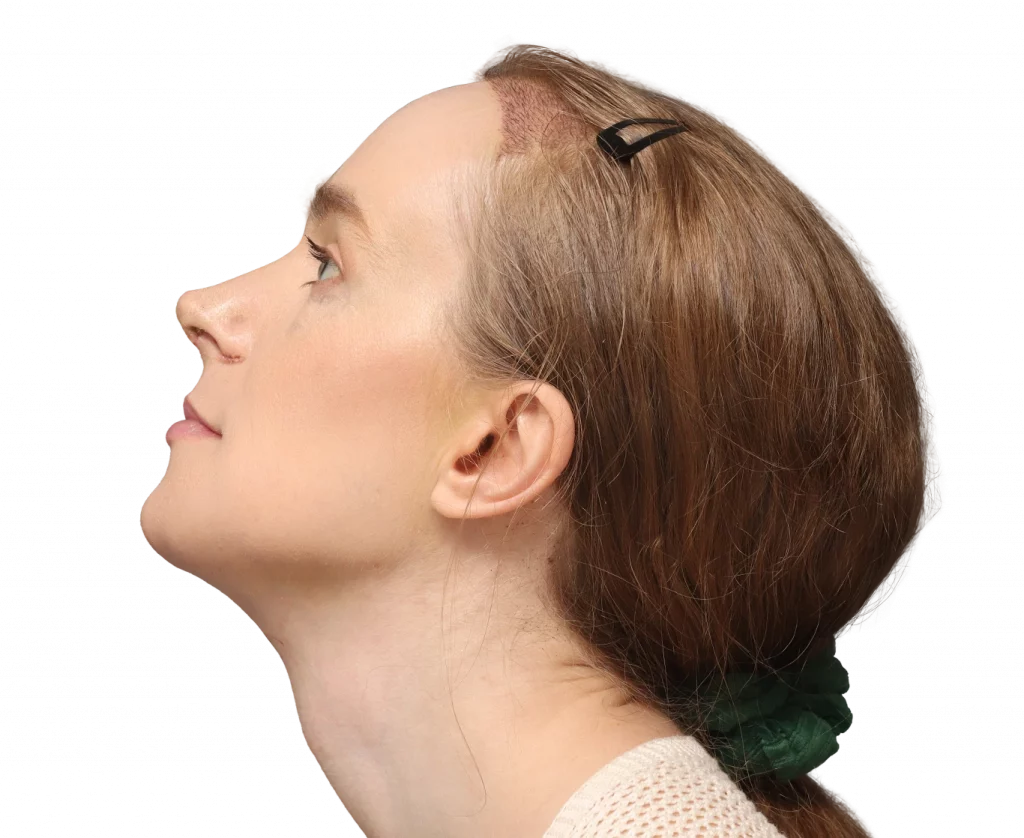 Linkes Profilbild von Joanna nach der Operation.
