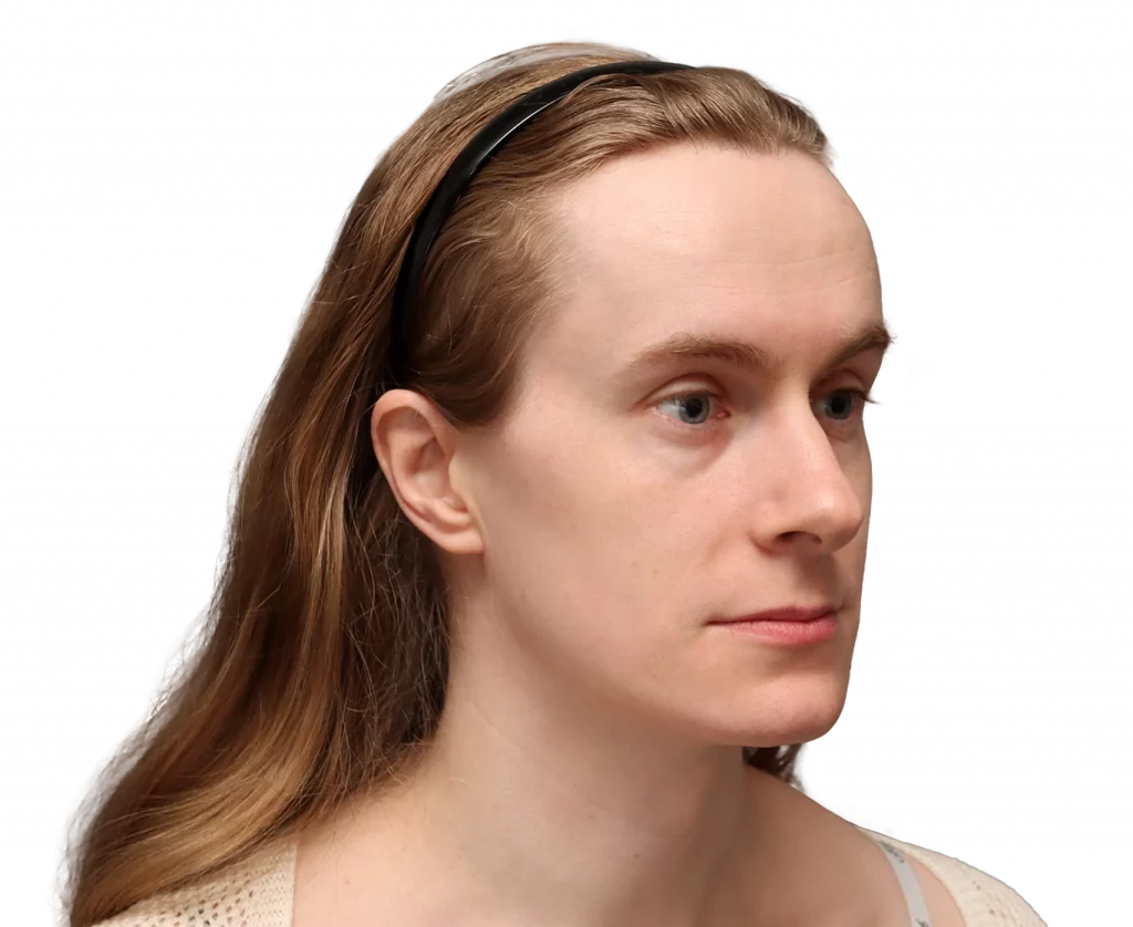 Schräges rechtes Profilfoto von Joanna vor der Operation.