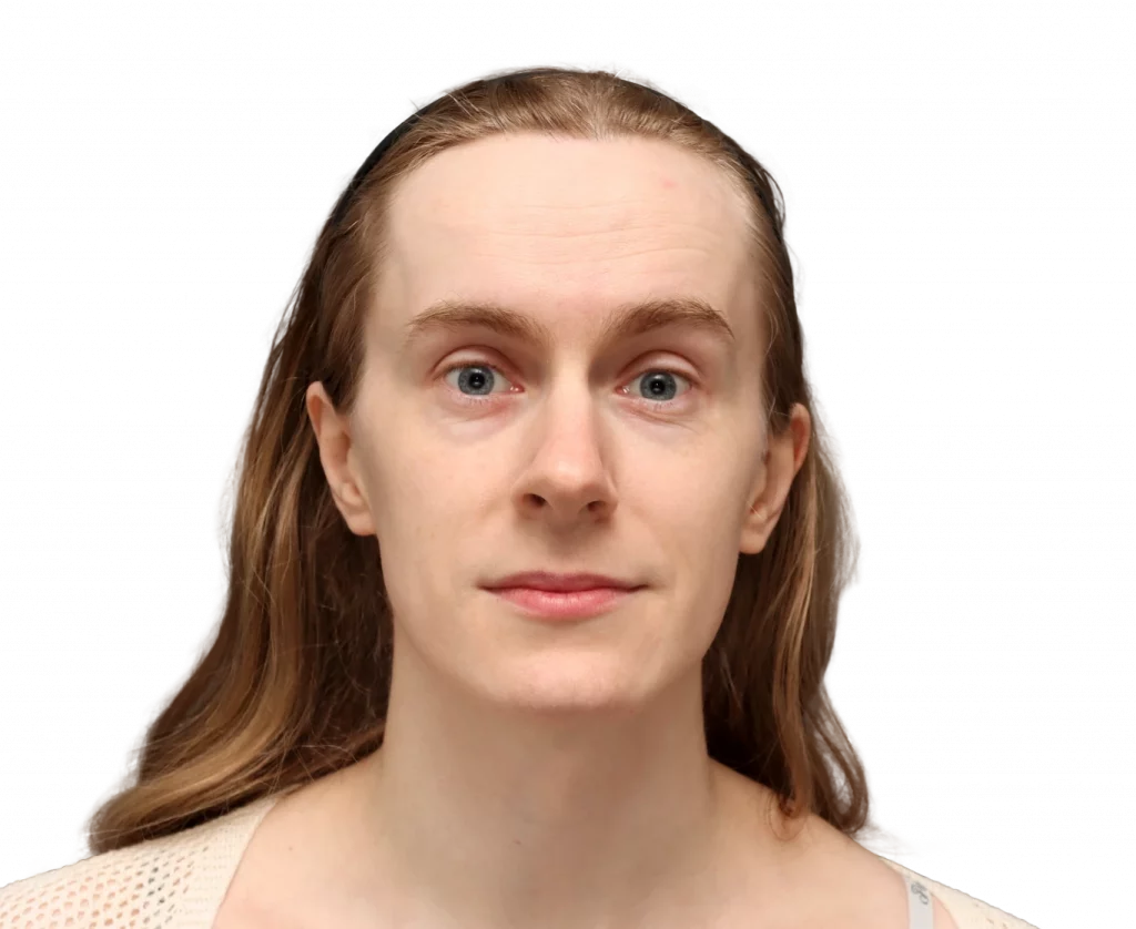 Frontalprofilbild von Joanna vor der Operation.