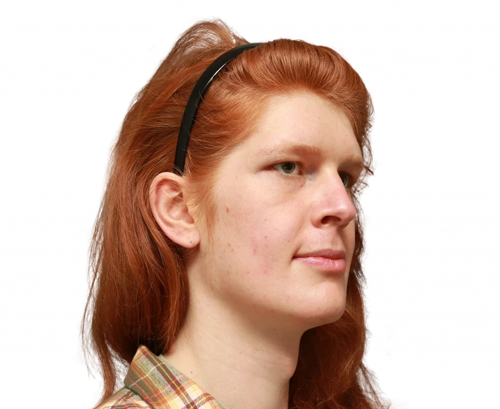 Rechtwinkliges Profilfoto von Luna L. vor der Operation.