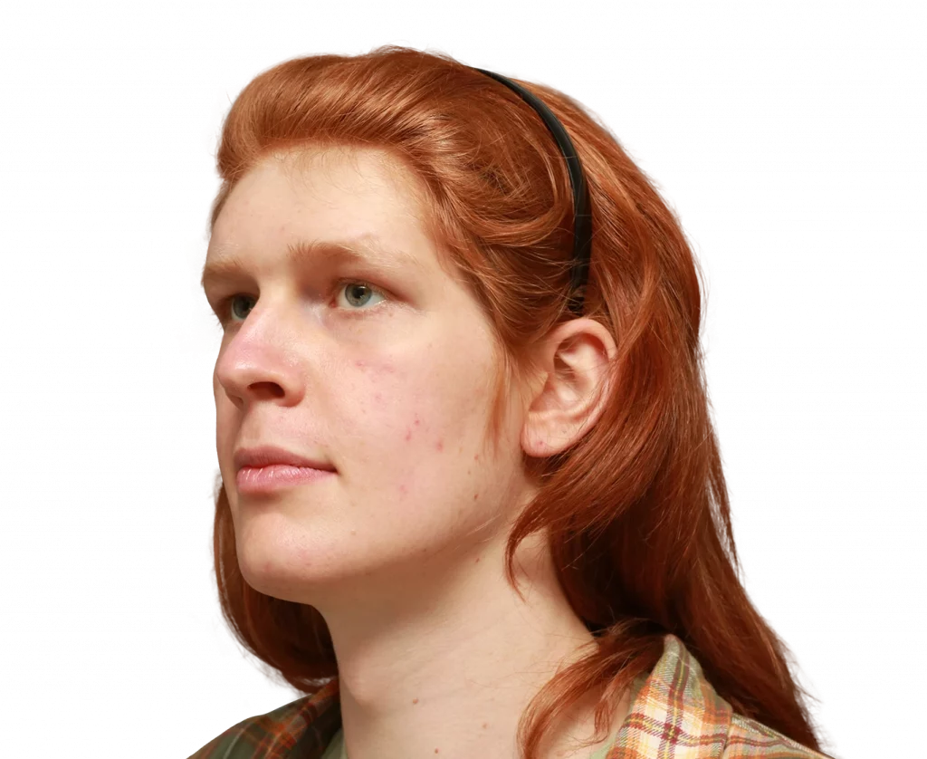 Linksgewinkeltes Profilfoto von Luna L. vor der Operation.