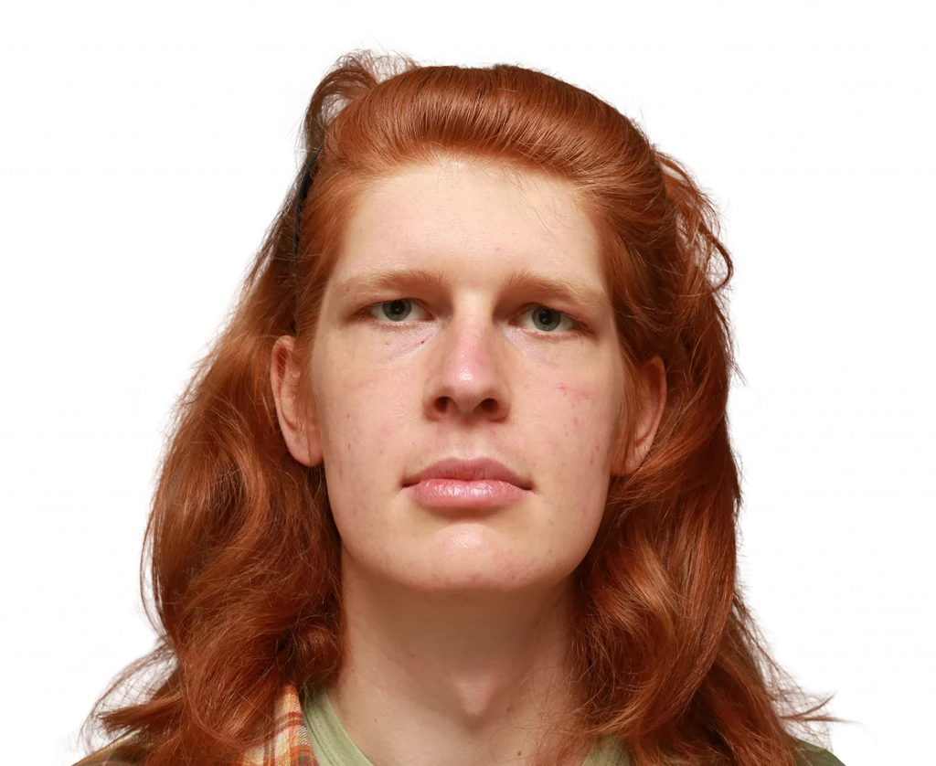 Frontalprofilbild von Luna L. vor der Operation.