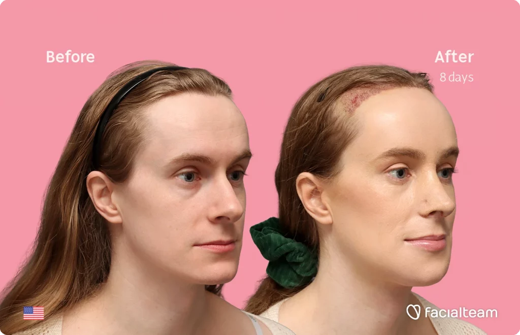 Schräges rechtes Bild der FFS-Patientin Joanna, das die Ergebnisse vor und nach der Facialteam-Operation zeigt, bestehend aus Stirn mit SHT, Nasenkorrektur, Trachealrasur und Kinnfeminisierung.