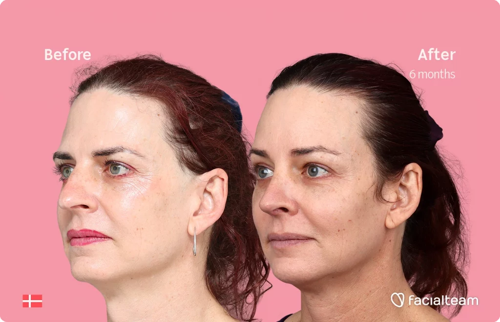 Schräges linkes Bild der FFS-Patientin Allison, das die Ergebnisse vor und nach der Facialteam-Operation zeigt, die aus einer Feminisierung der Stirn und einer Nasenkorrektur besteht.