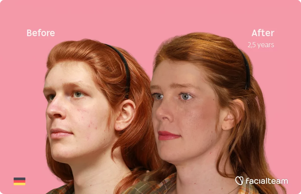 Schräges linkes Bild der FFS-Patientin Luna, das die Ergebnisse vor und nach der Facialteam-Operation zeigt, bestehend aus Stirn, Nasenkorrektur, Trachealrasur, Kinn- und Kieferfeminisierung.