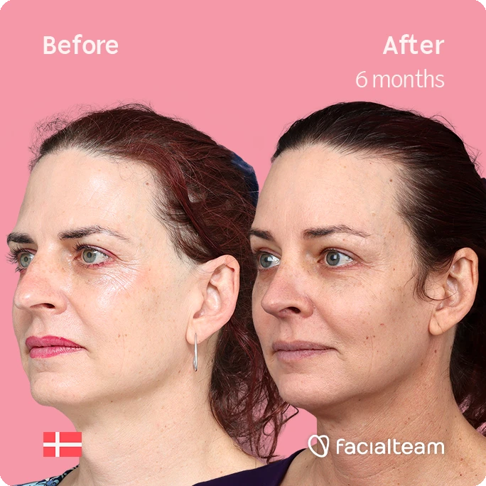 Schräges linkes quadratisches Bild der FFS-Patientin Allison, das die Ergebnisse vor und nach der Facialteam-Operation zeigt, die aus einer Feminisierung der Stirn und einer Nasenkorrektur besteht.