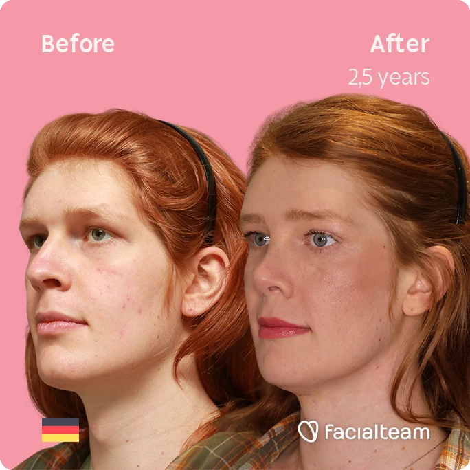 Schräges, quadratisches Bild links von FFS-Patientin Luna, das die Ergebnisse vor und nach der Facialteam-Operation zeigt, die aus Stirn, Nasenkorrektur, Trachealrasur, Kinn- und Kieferfeminisierung besteht.