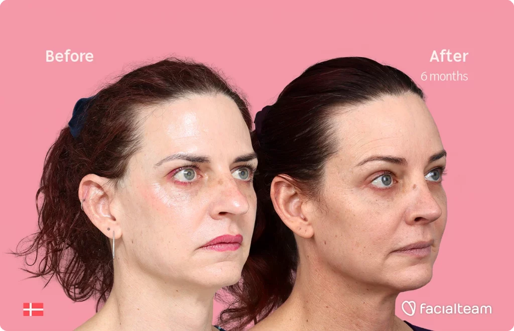 Schräges rechtes Bild der FFS-Patientin Allison, das die Ergebnisse vor und nach der Facialteam-Operation zeigt, die aus einer Feminisierung der Stirn und einer Nasenkorrektur besteht.