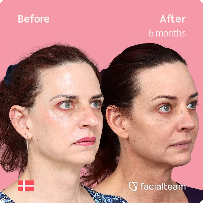 Schräges rechtes quadratisches Bild der FFS-Patientin Allison, das die Ergebnisse vor und nach der Facialteam-Operation zeigt, die aus einer Feminisierung der Stirn und einer Nasenkorrektur besteht.