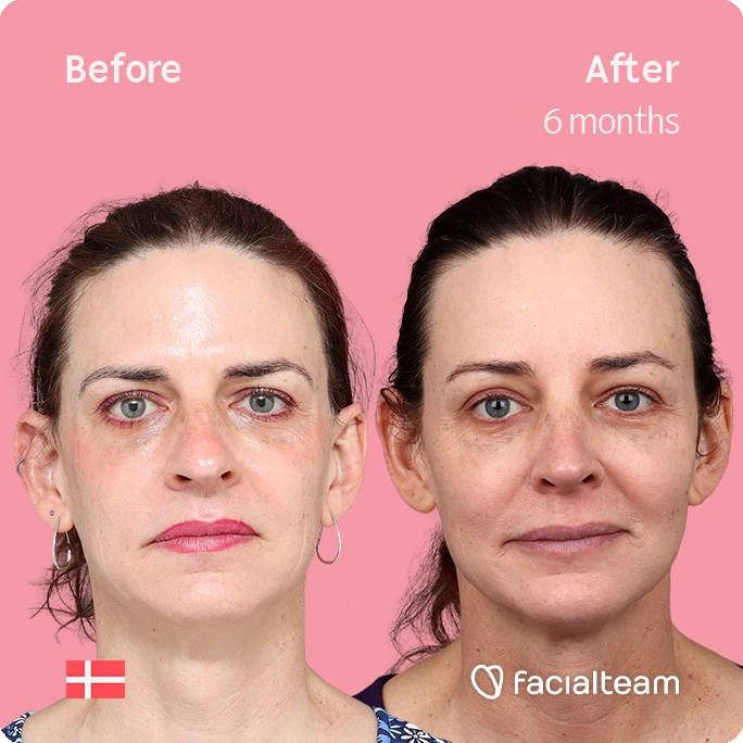 Frontales, quadratisches Bild der FFS-Patientin Allison, das die Ergebnisse vor und nach der Facialteam-Operation zeigt, die aus einer Feminisierung der Stirn und einer Nasenkorrektur besteht.