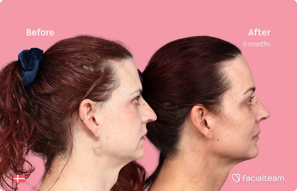 Seitliches rechtes Bild der FFS-Patientin Allison, das die Ergebnisse vor und nach der Facialteam-Operation zeigt, die aus einer Feminisierung der Stirn und einer Nasenkorrektur besteht.