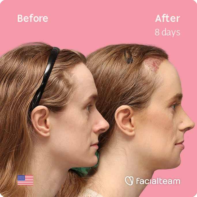 Quadratisches Bild der FFS-Patientin Joanna an der rechten Seite, das die Ergebnisse vor und nach der Facialteam-Operation zeigt, bestehend aus Stirn mit SHT, Nasenkorrektur, Trachealrasur und Kinnfeminisierung.