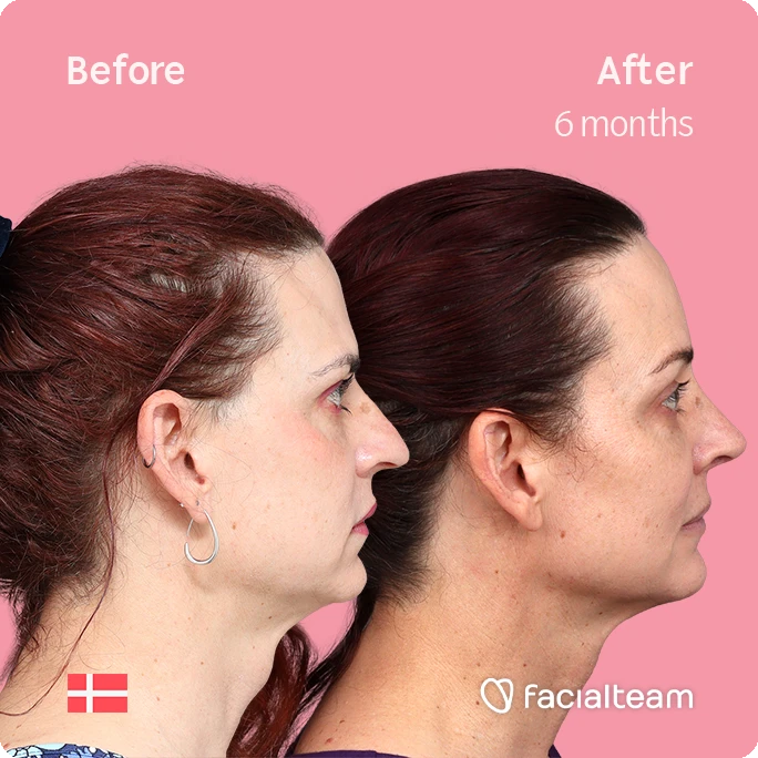 Quadratisches Bild der FFS-Patientin Allison an der rechten Seite, das die Ergebnisse vor und nach der Facialteam-Operation zeigt, die aus einer Feminisierung der Stirn und einer Nasenkorrektur besteht.
