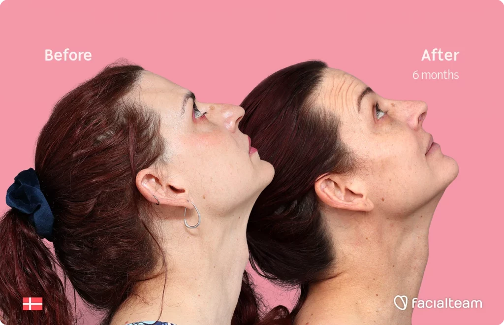 Das Bild der FFS-Patientin Allison von rechts oben zeigt das Ergebnis vor und nach der Facialteam-Operation, bestehend aus Stirn- und Nasenkorrektur, Feminisierung.