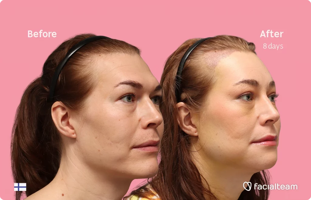 Rechte Profilansicht in Schrägaufnahme von Juuli, die ihre Vorher-Nachher-Transformation der FFS mit Facialteam zeigt: Stirn mit SHT, Kinn und Kiefer, mit HIFU als ergänzendem Eingriff.