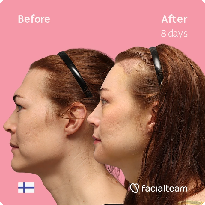 Quadratische Seitenansicht (linkes Profil) von Juuli, die ihre Vorher-Nachher-Transformation der FFS mit Facialteam zeigt: Stirn mit SHT, Kinn und Kiefer, mit HIFU als ergänzendem Eingriff.