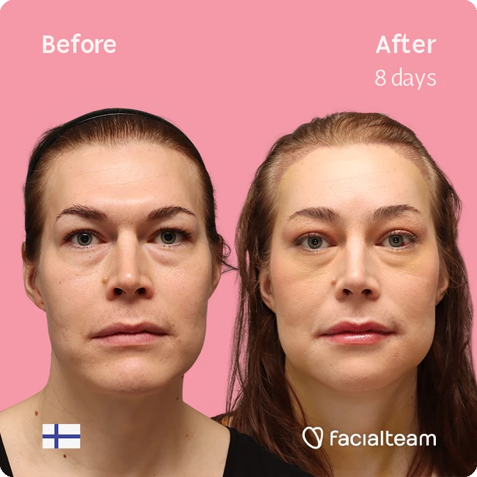 Quadratische Frontaufnahme von Juuli, die ihre Vorher-Nachher-Transformation der FFS mit Facialteam zeigt: Stirn mit SHT, Kinn und Kiefer, mit HIFU als ergänzendem Eingriff.