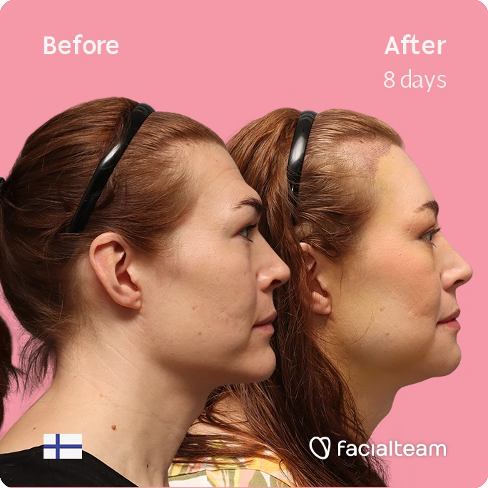 Quadratische Seitenansicht (rechtes Profil) von Juuli, die ihre Vorher-Nachher-Transformation der FFS mit Facialteam zeigt: Stirn mit SHT, Kinn und Kiefer, mit HIFU als ergänzendem Eingriff.