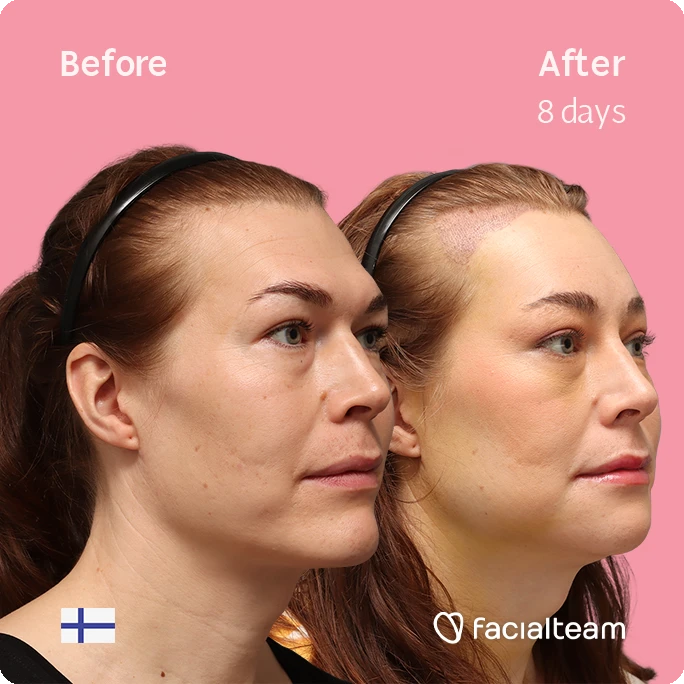 Quadratische Seitenansicht in Schrägaufnahme von Juuli, die ihre Vorher-Nachher-Transformation der FFS mit Facialteam zeigt: Stirn mit SHT, Kinn und Kiefer, mit HIFU als ergänzendem Eingriff.
