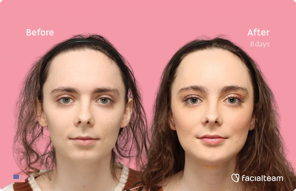 Frontansicht von Alex M, die ihre Vorher-Nachher-Transformation der FFS mit Facialteam zeigt: Stirn, Kinn und Adamsapfelreduktion.