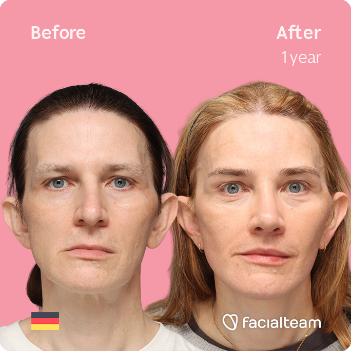 Quadratische Frontansicht von Nina S, die ihre Vorher-Nachher-Transformation der FFS mit Facialteam zeigt: Stirn, Nasenkorrektur und Adamsapfelreduktion, mit zervikofazialem Lifting und Lippenfeminisierung als ergänzende Eingriffe.