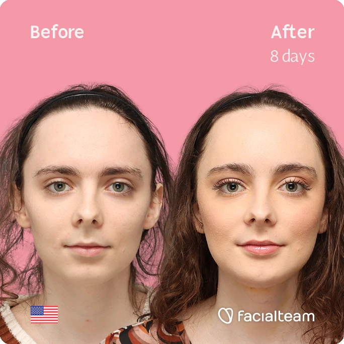 Quadratische Frontansicht von Alex M, die ihre Vorher-Nachher-Transformation der FFS mit Facialteam zeigt: Stirn, Kinn und Adamsapfelreduktion.