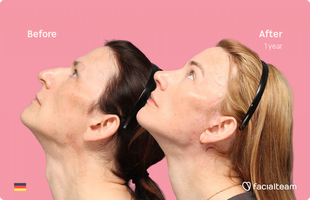 Rechte Profilansicht aus leicht erhöhtem Winkel von Nina S, die ihre Vorher-Nachher-Transformation der FFS mit Facialteam zeigt: Stirn, Nasenkorrektur und Adamsapfelreduktion, mit zervikofazialem Lifting und Lippenfeminisierung als ergänzende Eingriffe.