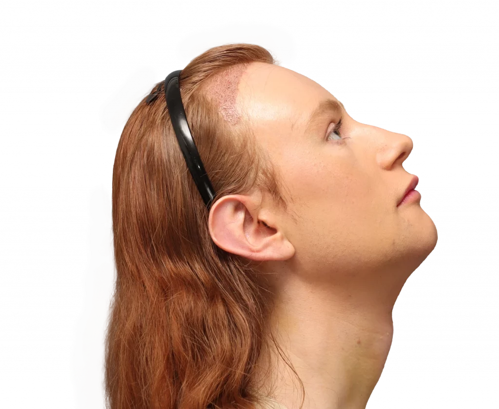 Rechtes Profil von oben von Annah nach der Operation.