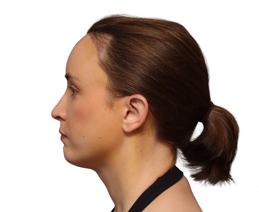 Linkes Profil von Erin nach der Operation.