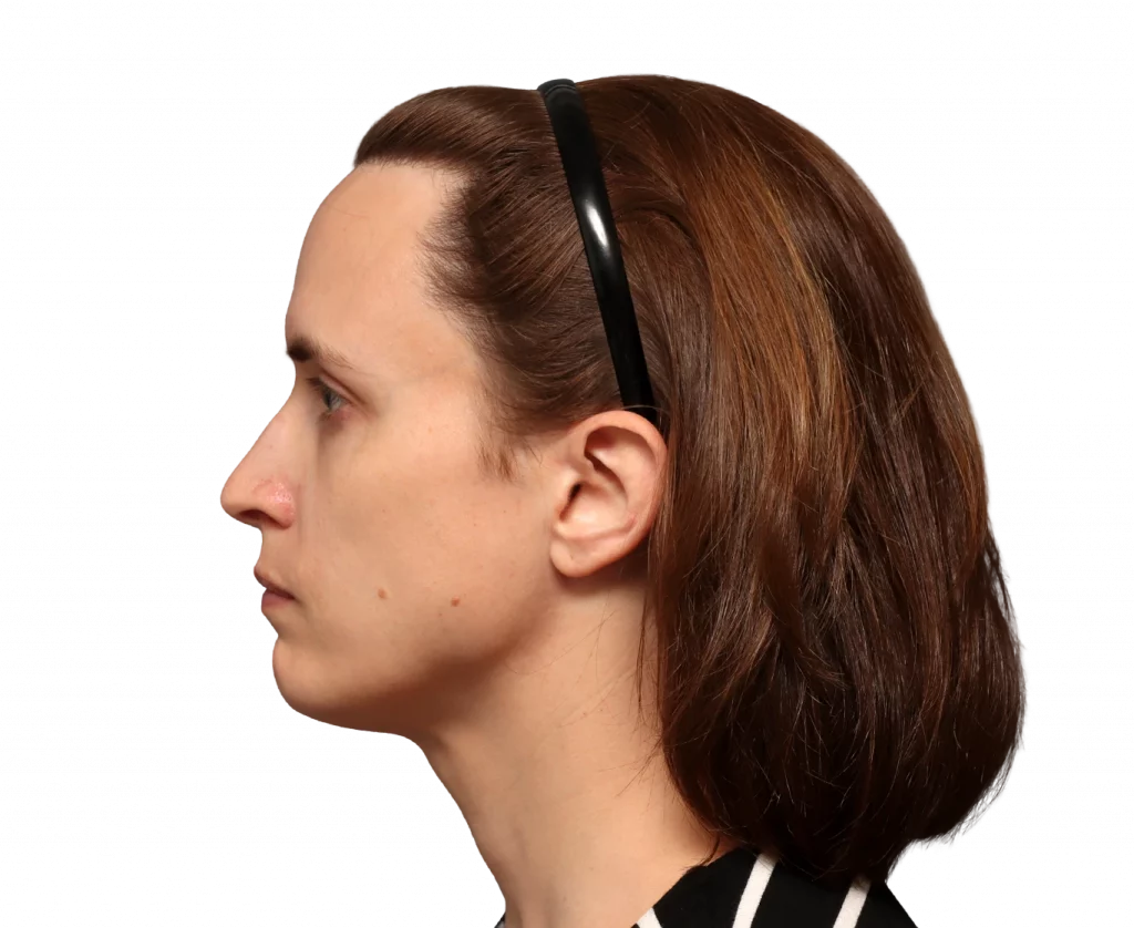 Linkes Profil von Erin vor der Operation.