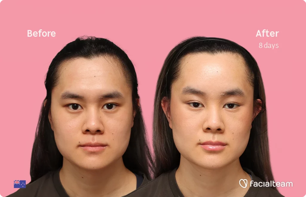 Frontansicht der FFS-Patientin Val, die die Ergebnisse vor und nach der Behandlung bei Facialteam zeigt, bestehend aus Stirnfeminisation.