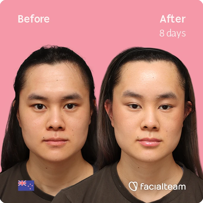 Frontansicht quadratisch der FFS-Patientin Val, die die Ergebnisse vor und nach der Behandlung bei Facialteam zeigt, bestehend aus Stirnfeminisation.