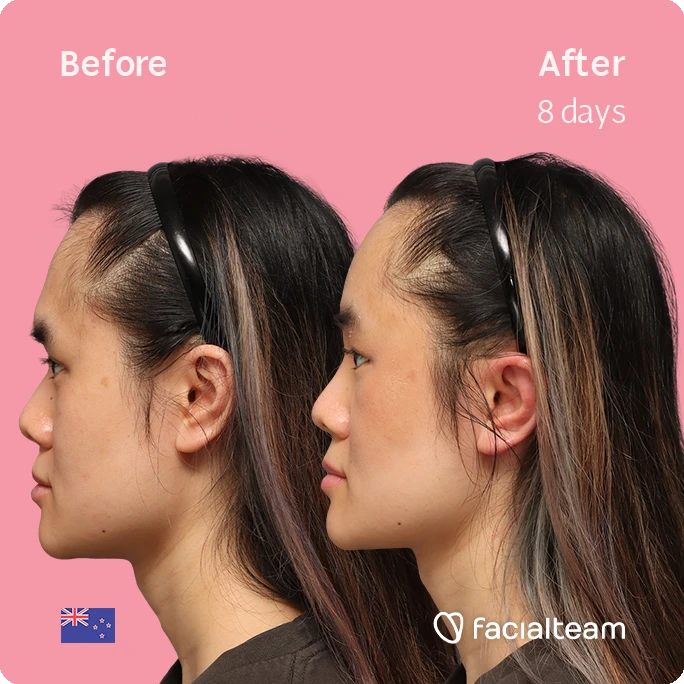 Linkes Profil quadratisch der FFS-Patientin Val, das die Ergebnisse vor und nach der Behandlung bei Facialteam zeigt, bestehend aus Stirnfeminisation.