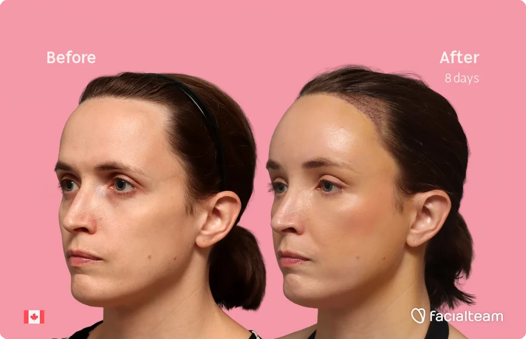 Schrägaufnahme des linken Profils von Erin, die ihre Vorher-Nachher-Transformation der FFS mit Facialteam zeigt: Stirn mit SHT.